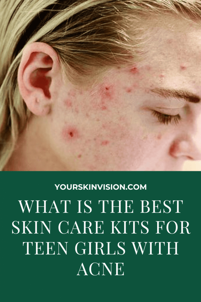 BEST SKIN CARE KITS FOR TEEN GIRLS WITH ACNE