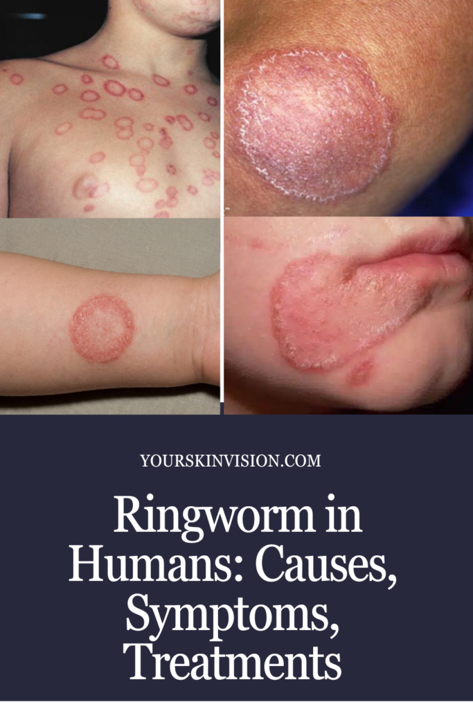 Ringworm in Humans: Causes, Symptoms, Treatments