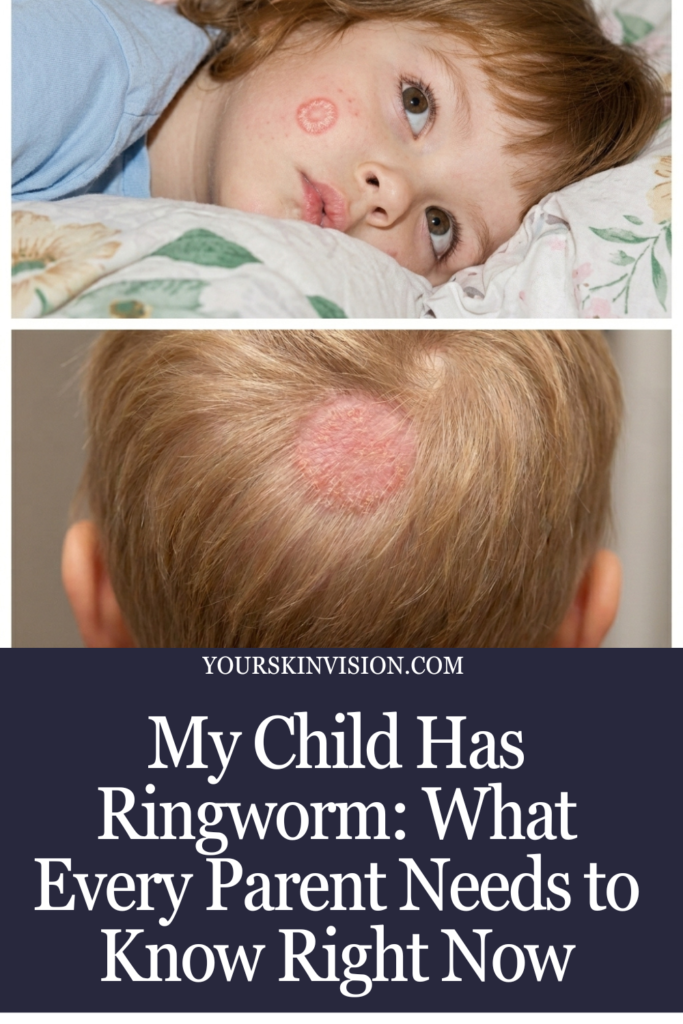 Ringworm In Kids: What Every Parent Needs to Know Right Now