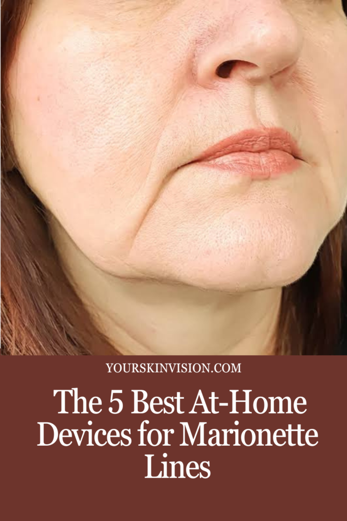 5 Best At-Home Devices for Marionette Lines