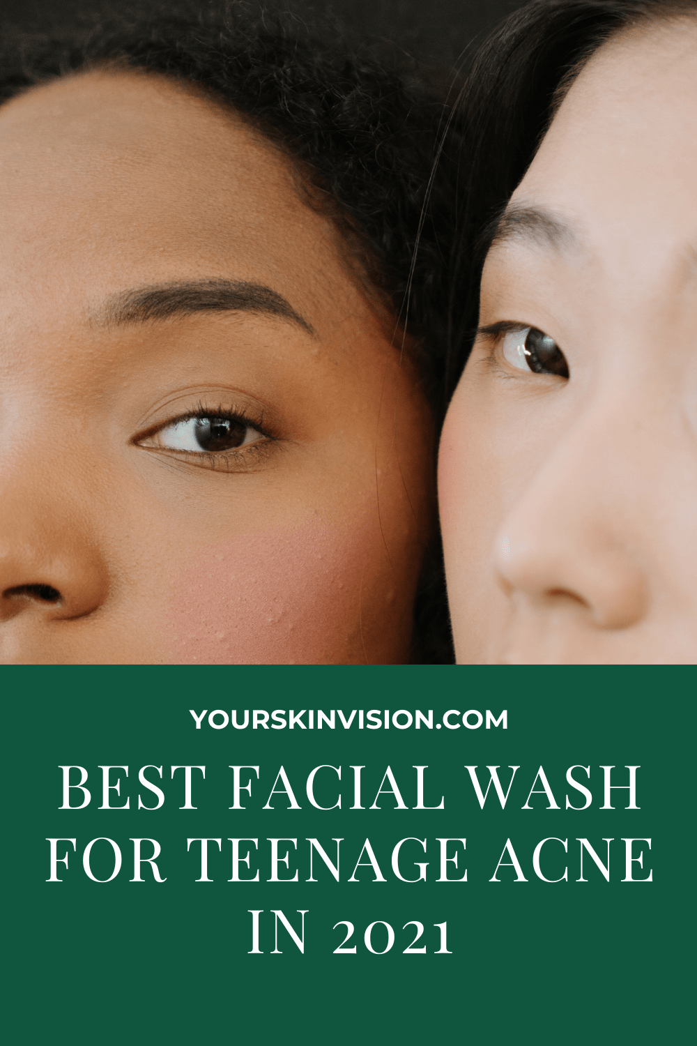 Best Facial Wash for Teenage Acne in 2021 YourSkinVision