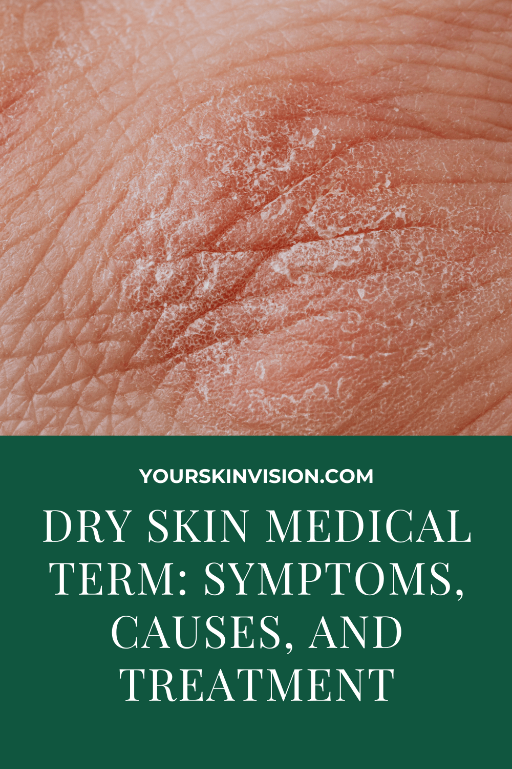 Dry Skin Medical Term Symptoms Causes And Treatment