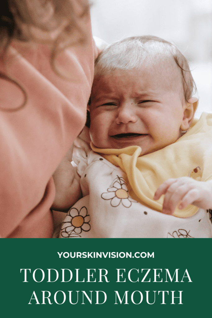 Toddler Eczema Around Mouth