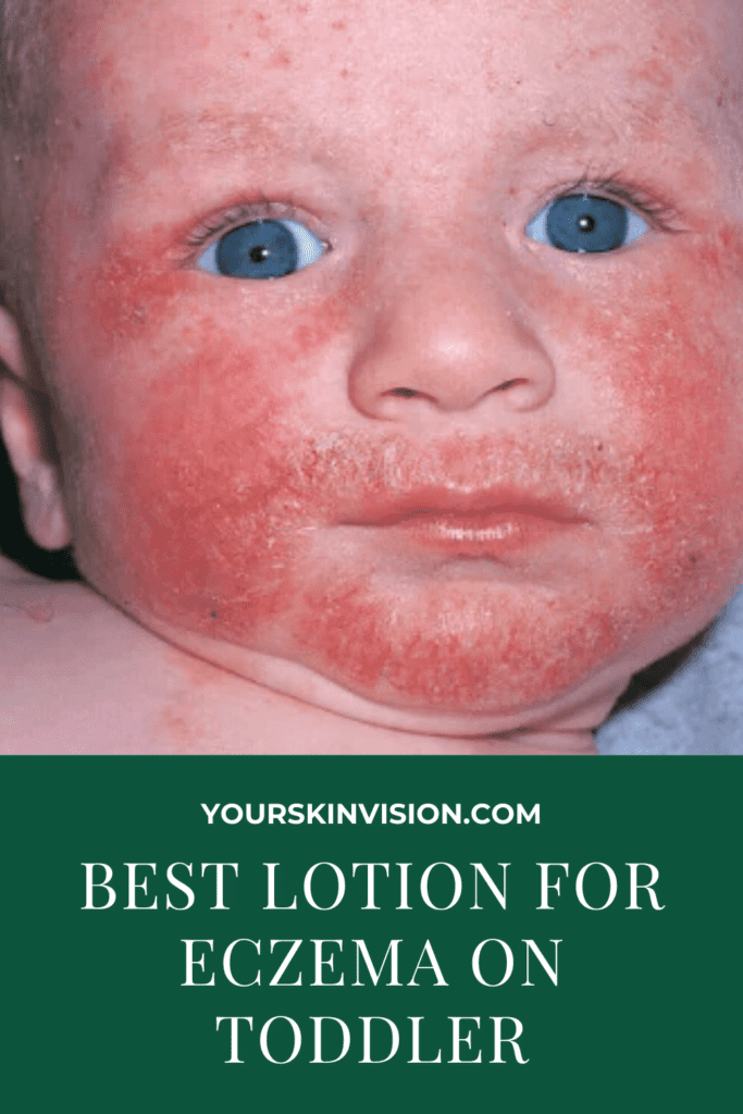 Best Lotion For Eczema On Toddler