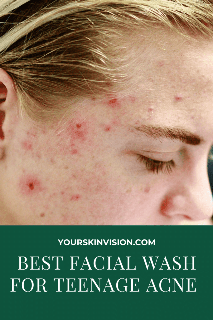 Best Facial Wash for Teenage Acne