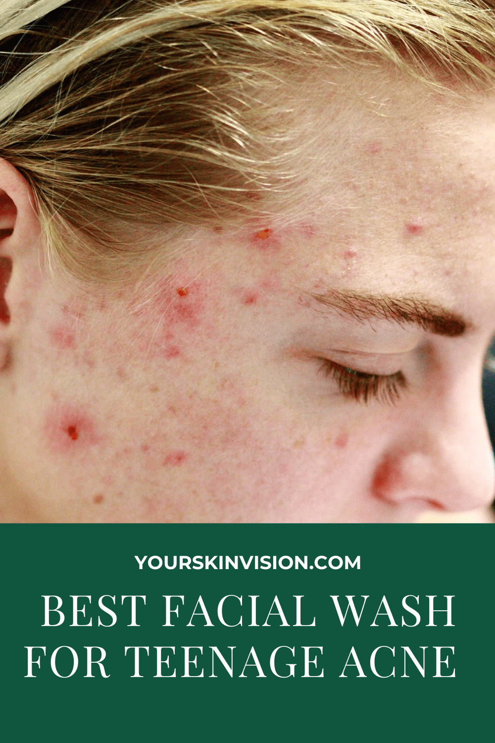 5 Best Facial Wash for Teenage Acne in 2024 YourSkinVision