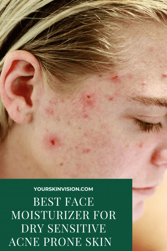 Best Face Moisturizer for Dry Sensitive Acne Prone Skin