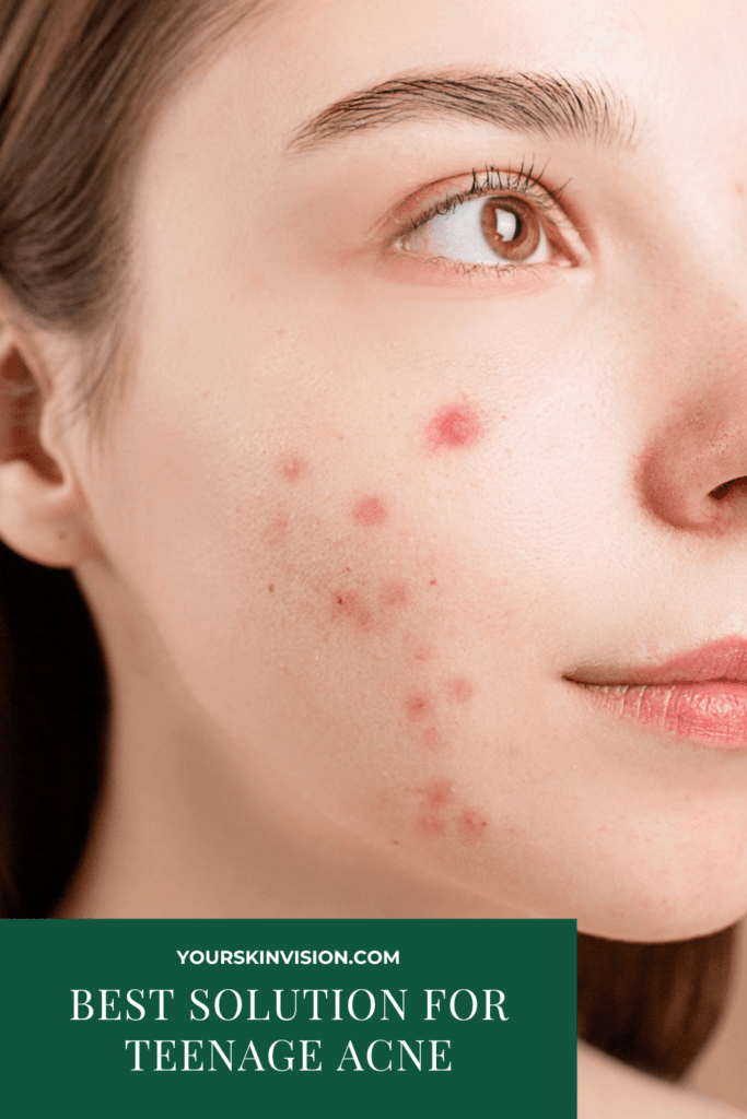 5 Best Solution For Teenage Acne In 2024   Best Solution For Teenage Acne 683x1024 