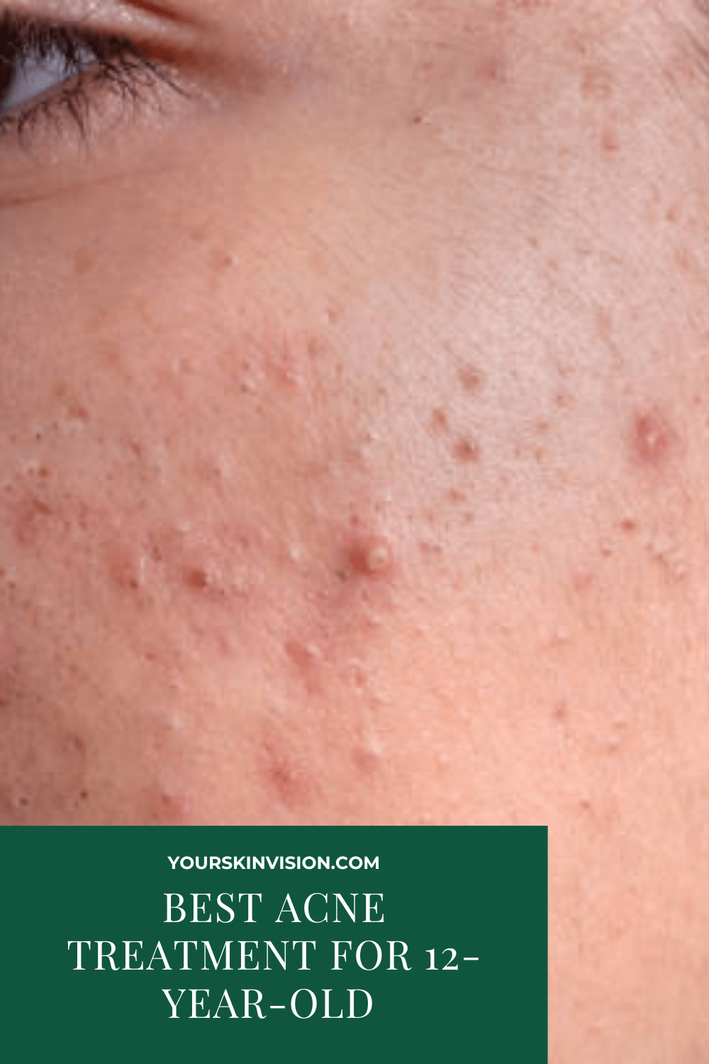 5 Best Acne Treatment For 12-Year-Old In 2024 - YourSkinVision