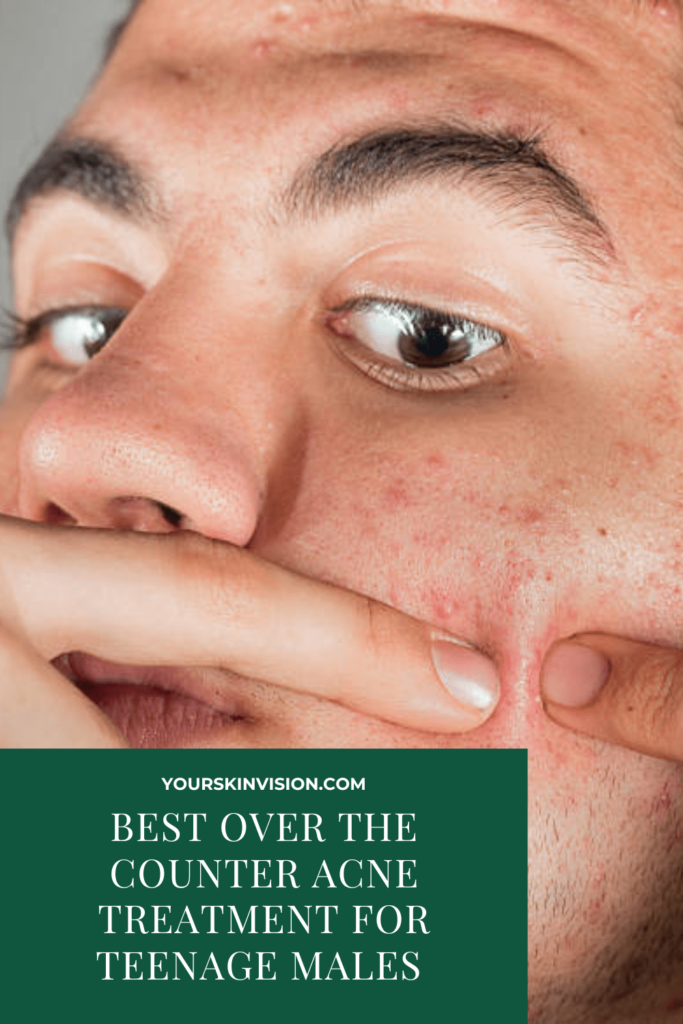 Best Over The Counter Acne Treatment For Teenage Males