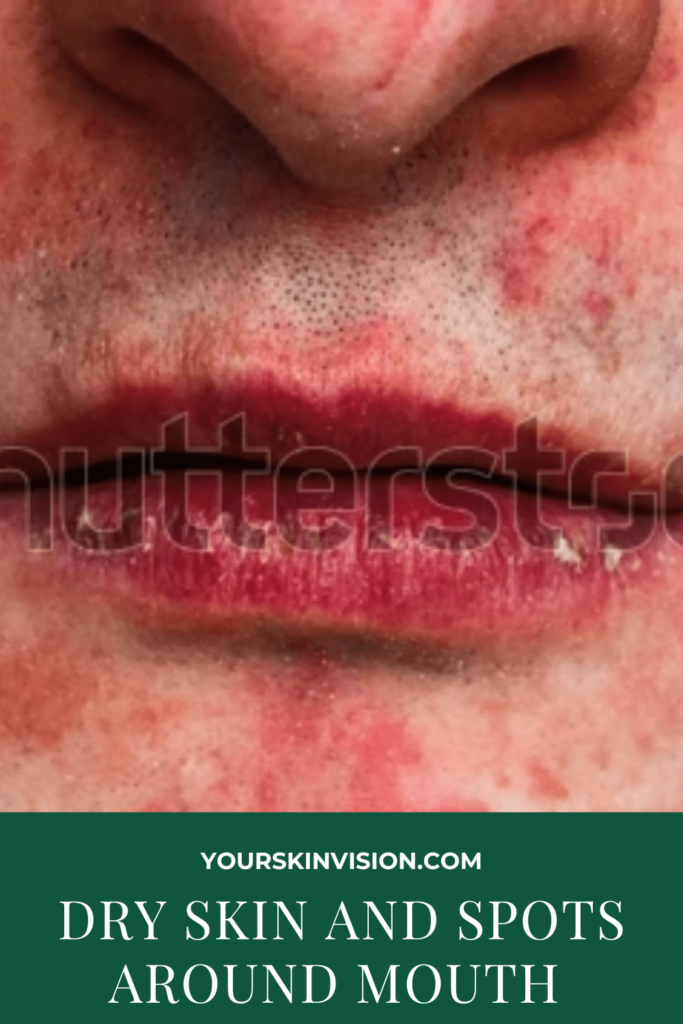 Dry Skin And Spots Around Mouth