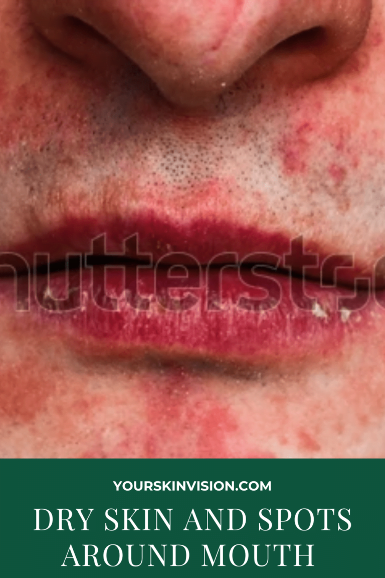 Dry Skin And Spots Around Mouth Causes And Treatments