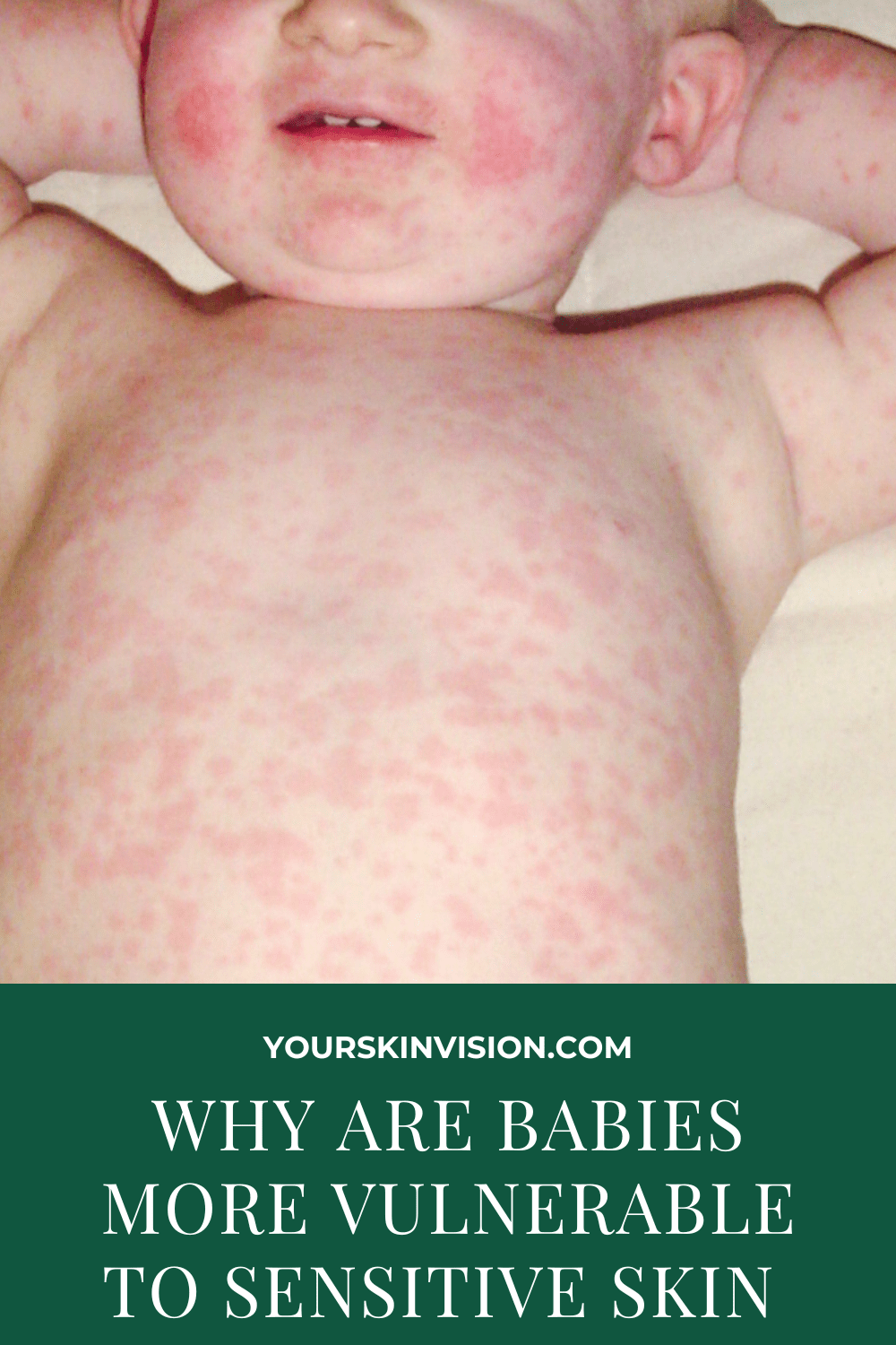 Why Are Babies More Vulnerable To Sensitive Skin? The Reasons