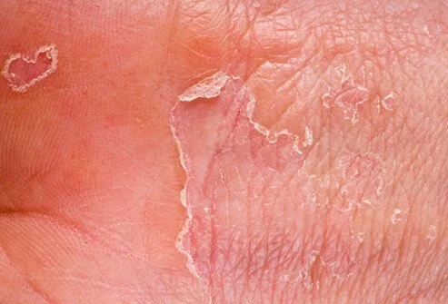 is dry skin eczema