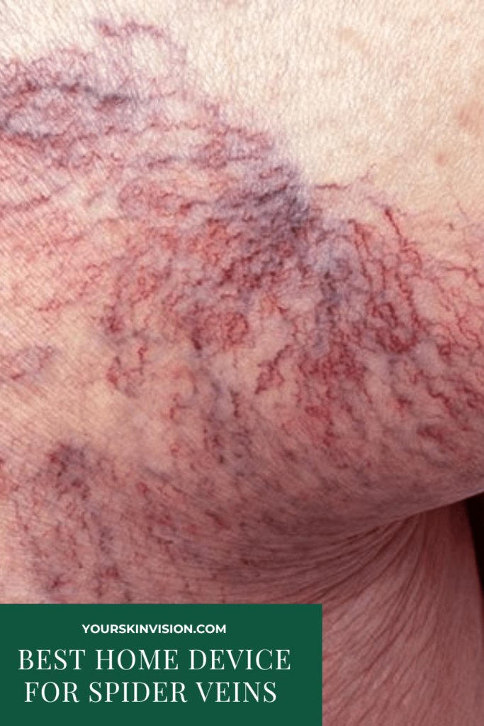 Best Home Device For Spider Veins