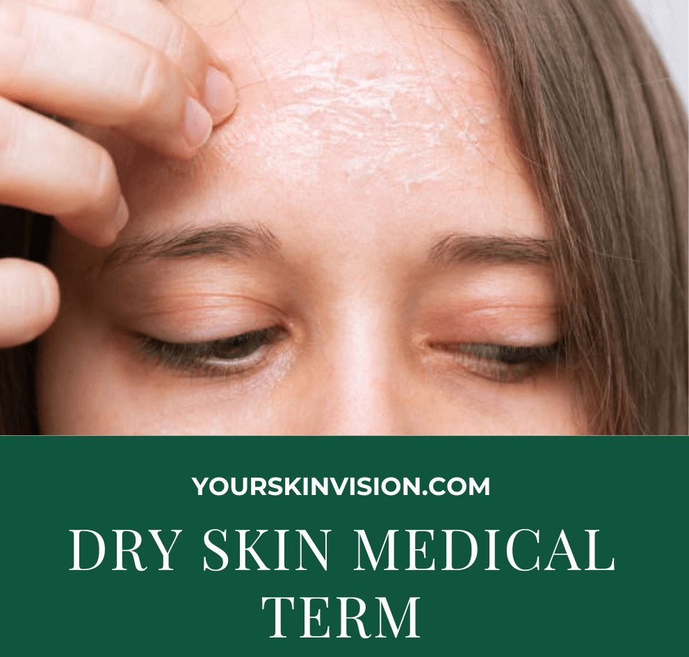 Dry Skin Medical Term