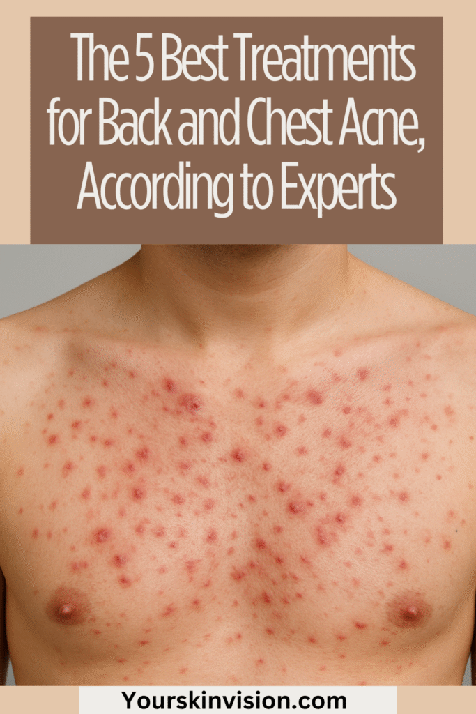 Picture of 5 Best Treatments for Back and Chest Acne, According to Experts