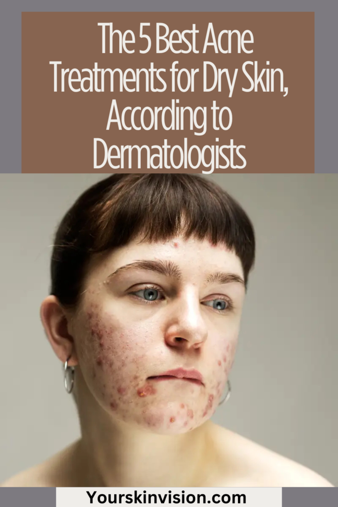 View of 5 Best Acne Treatments for Dry Skin, According to Dermatologists